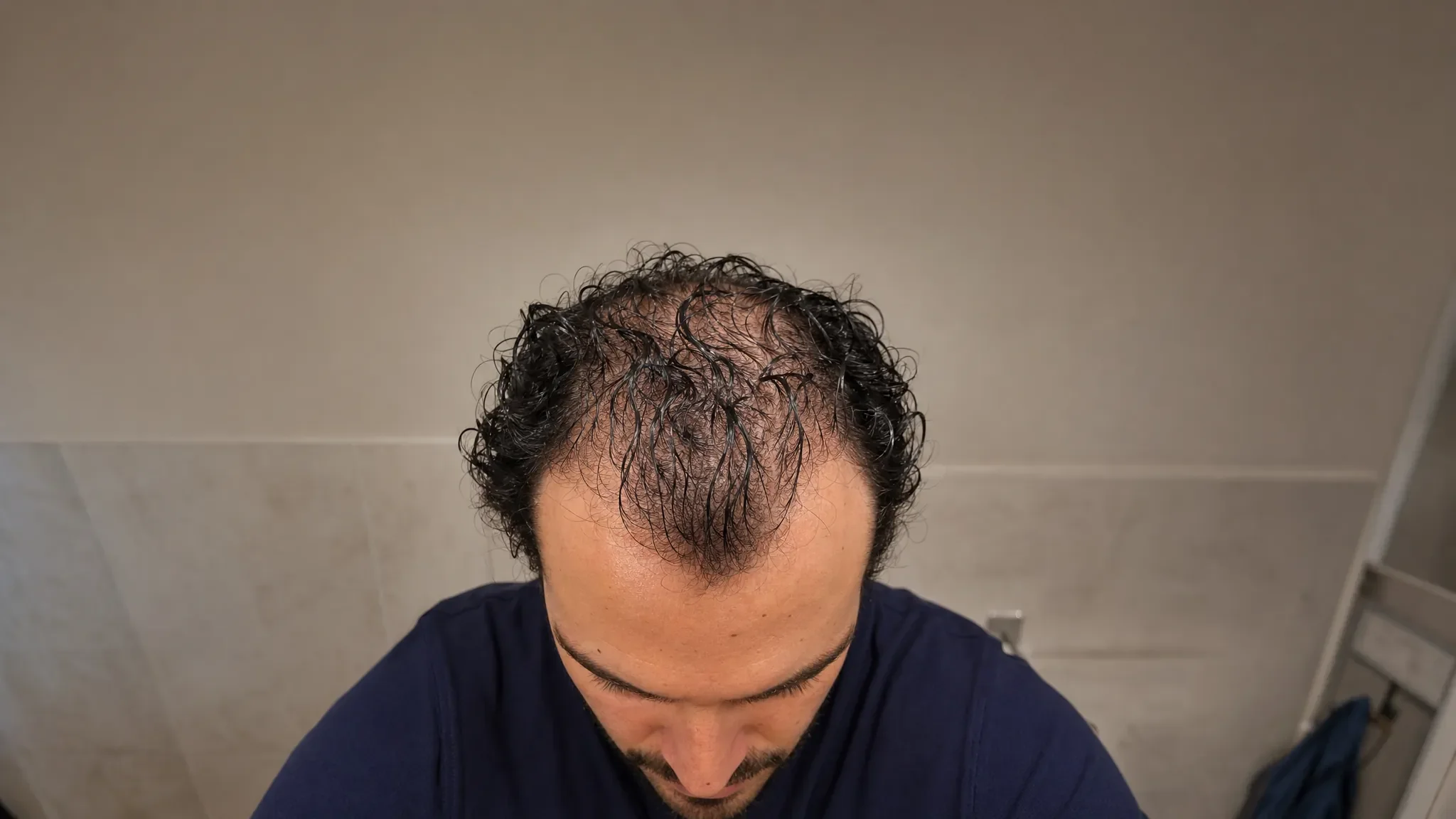 Recreación fotográfica: la densidad del cabello el día 1 del tratamiento capilar